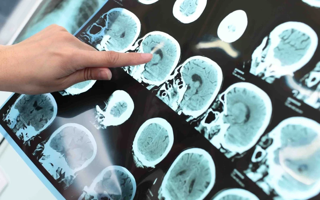 FDA aprueba primer medicamento que retrasa avance del Alzheimer